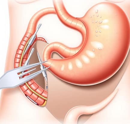 Single Anastomosis Surgery