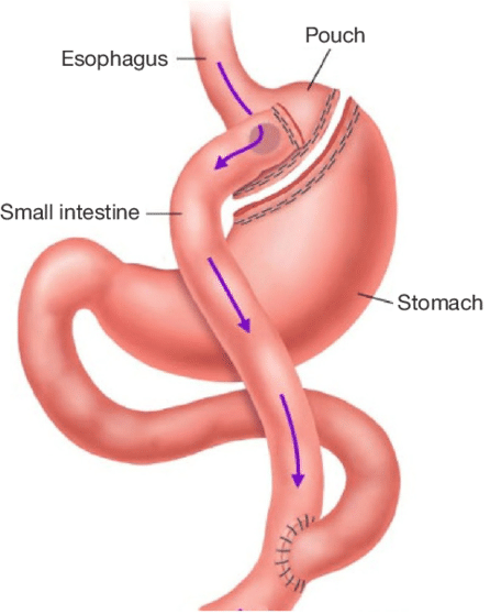 bariatric procedures